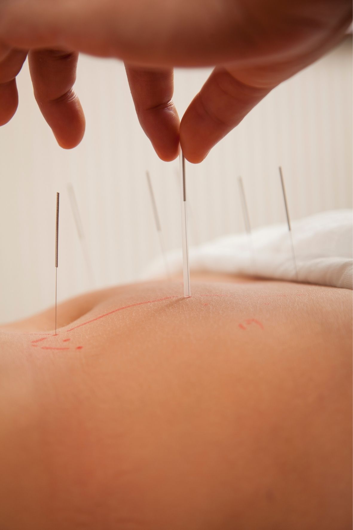 aiguille d’acupuncture placée sur la peau avec mains proches dans un environnement clinique Acupuncture à Oka