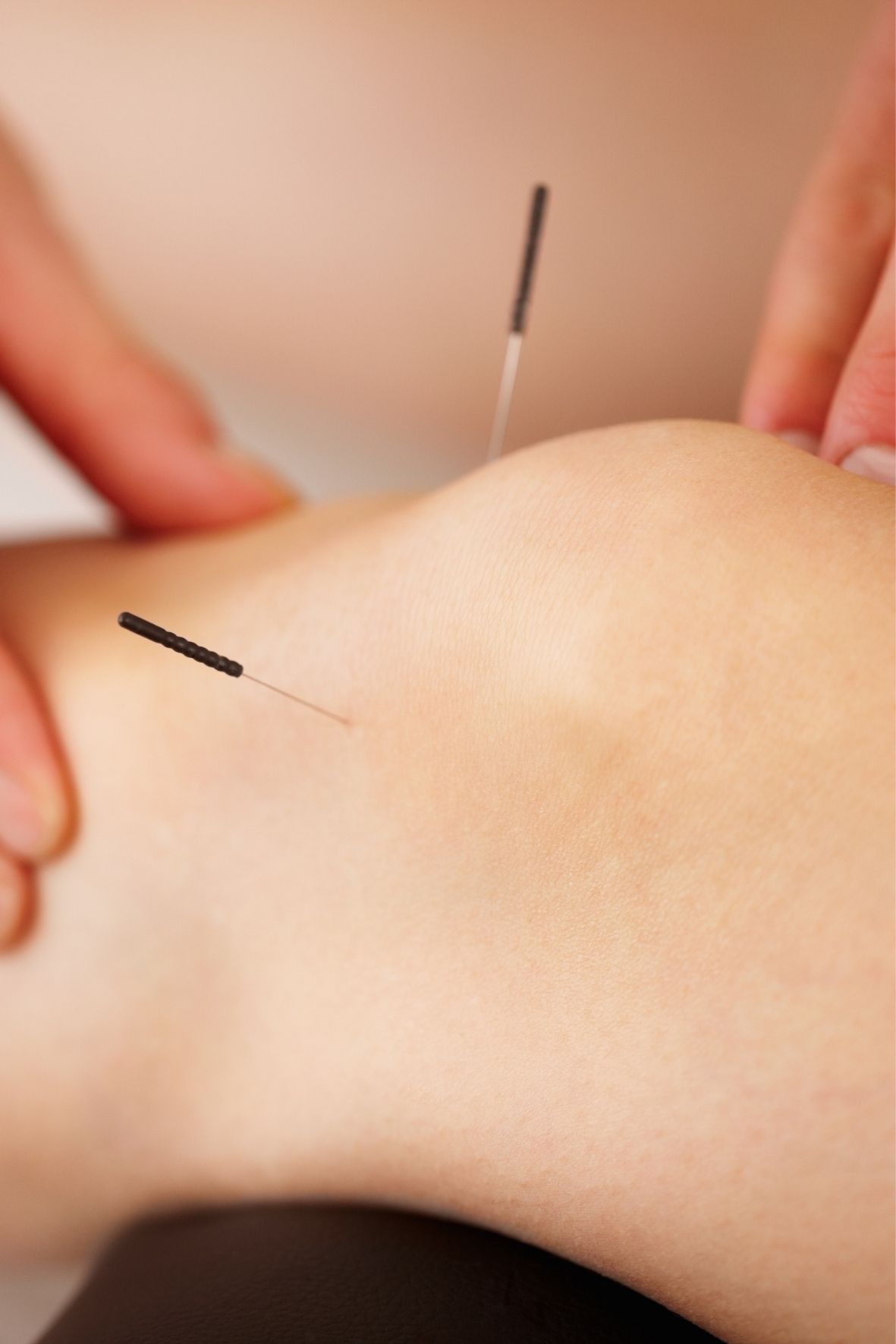 aiguille d’acupuncture placée sur la peau d’une personne allongée dans une ambiance de soin Acupuncture à Saint-Eustache