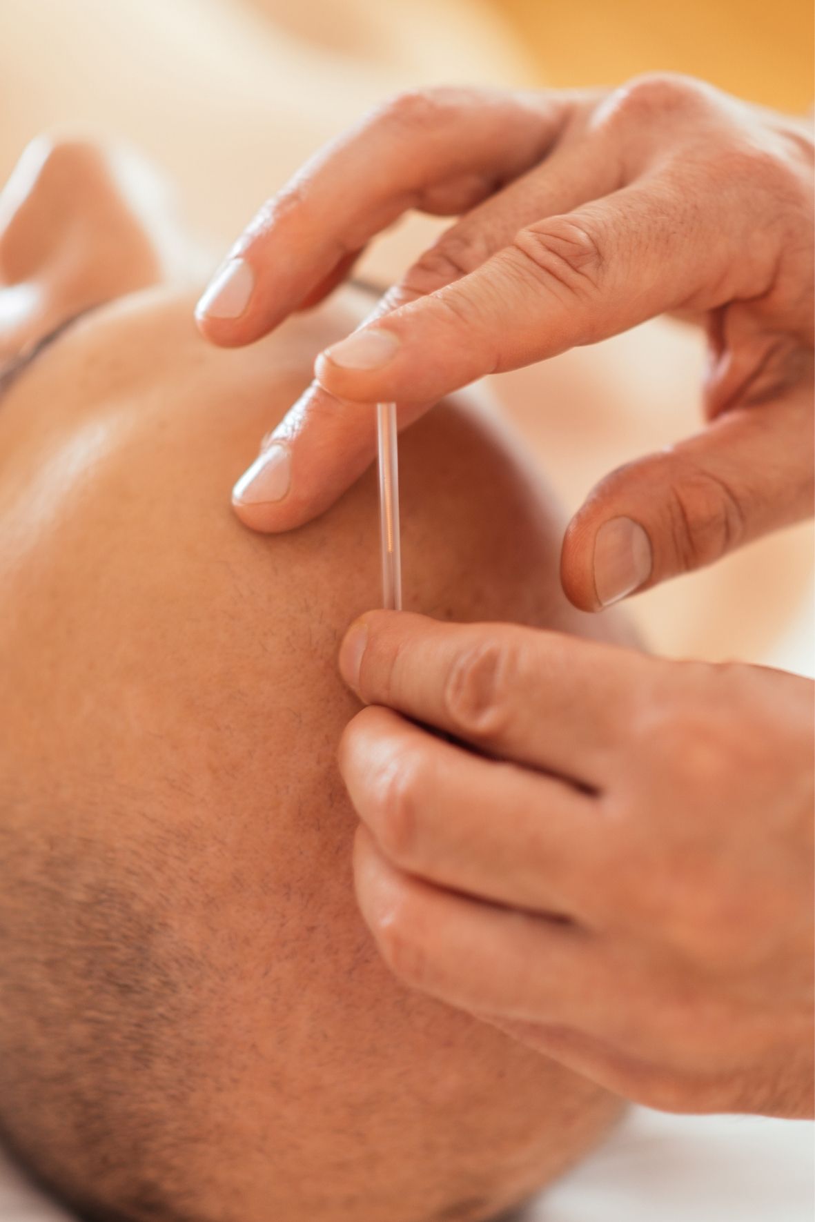 main positionnant une fine aiguille sur la peau d’une personne dans un contexte de séance d’acupuncture Acupuncture à Vaudreuil-Dorion