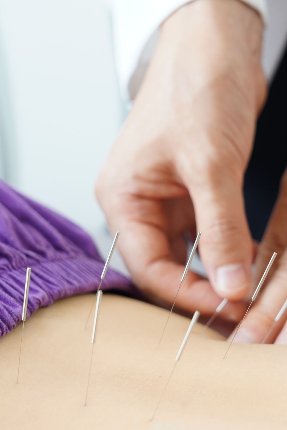 main ajustant plusieurs aiguilles d’acupuncture placées sur la peau dans un cadre calme Acupuncture à Windsor