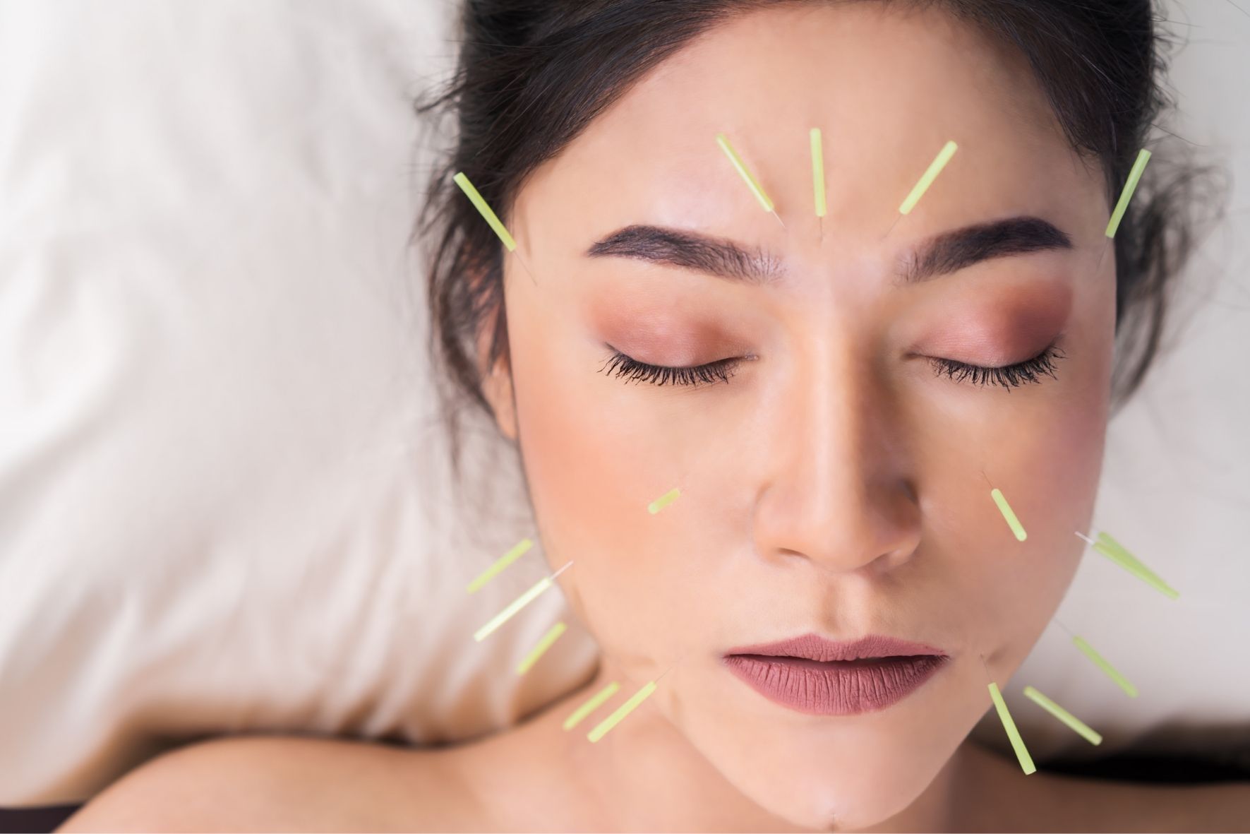 visage d’une personne avec plusieurs aiguilles d’acupuncture visibles sur le visage dans un contexte de séance Acupuncture au Nouveau-Brunswick
