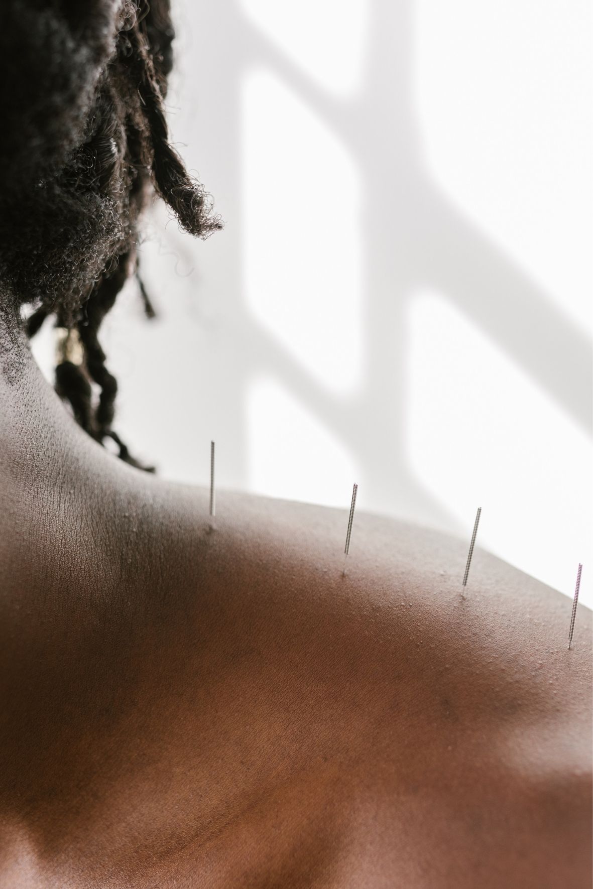 gros plan sur une épaule avec plusieurs aiguilles d’acupuncture insérées dans la peau dans un environnement lumineux Acupuncture en Outaouais